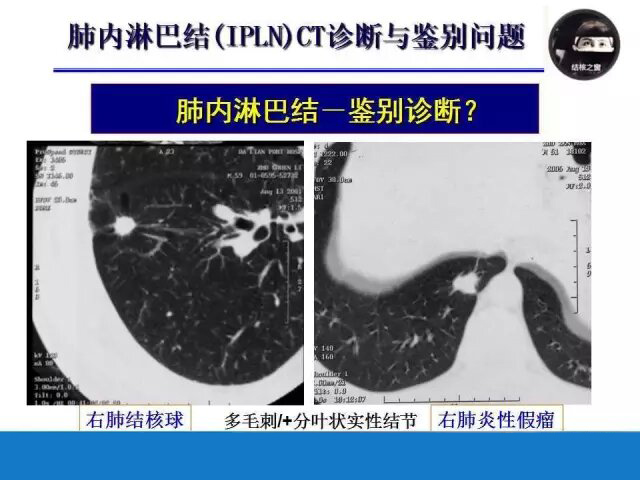 肺内淋巴结的ct表现与鉴别诊断