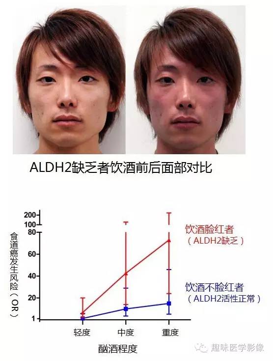 帕金森病的特征性表现之一:"面具脸"