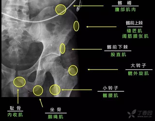 这7 种骨盆髋部骨折 80% 的骨科医生都会漏诊