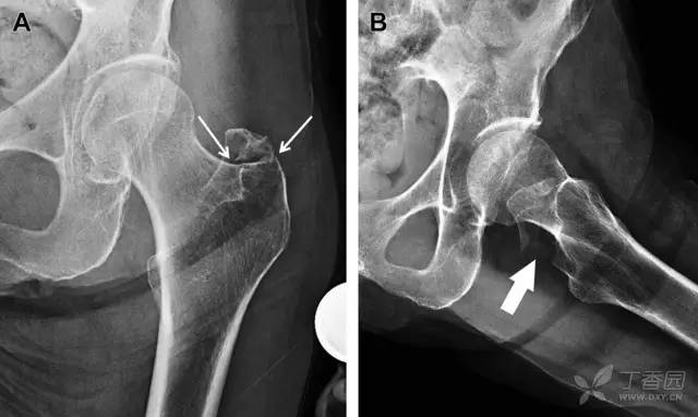 这7 种骨盆髋部骨折 80% 的骨科医生都会漏诊